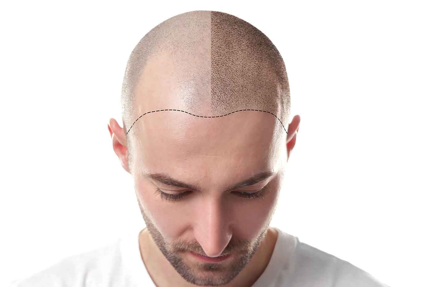 Hair Tattoo A New Technique to Camouflage Thinning Hair StyleSpeak